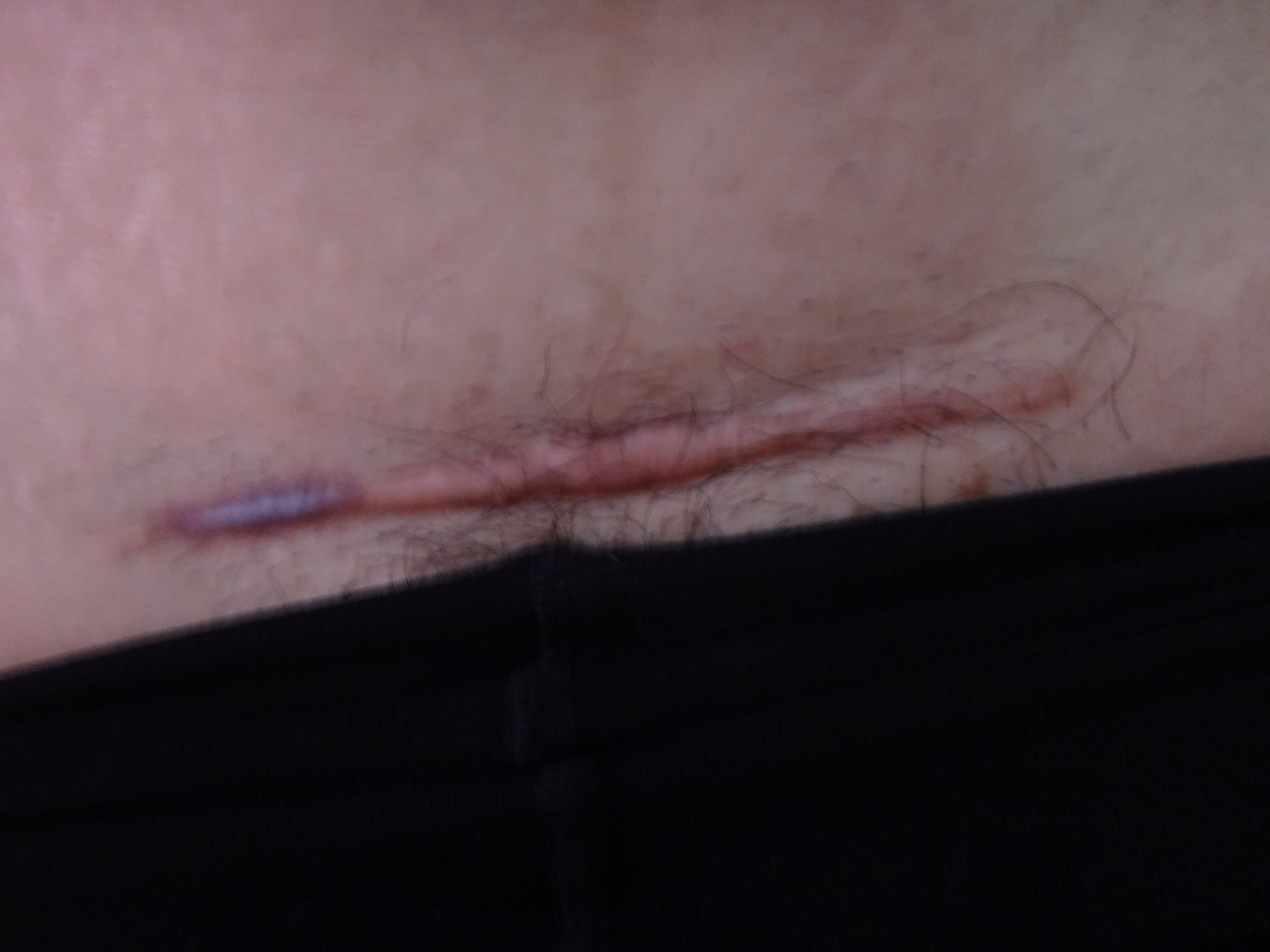 剖腹产手术