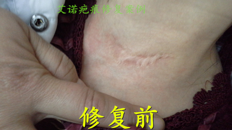 甲状腺疤痕1