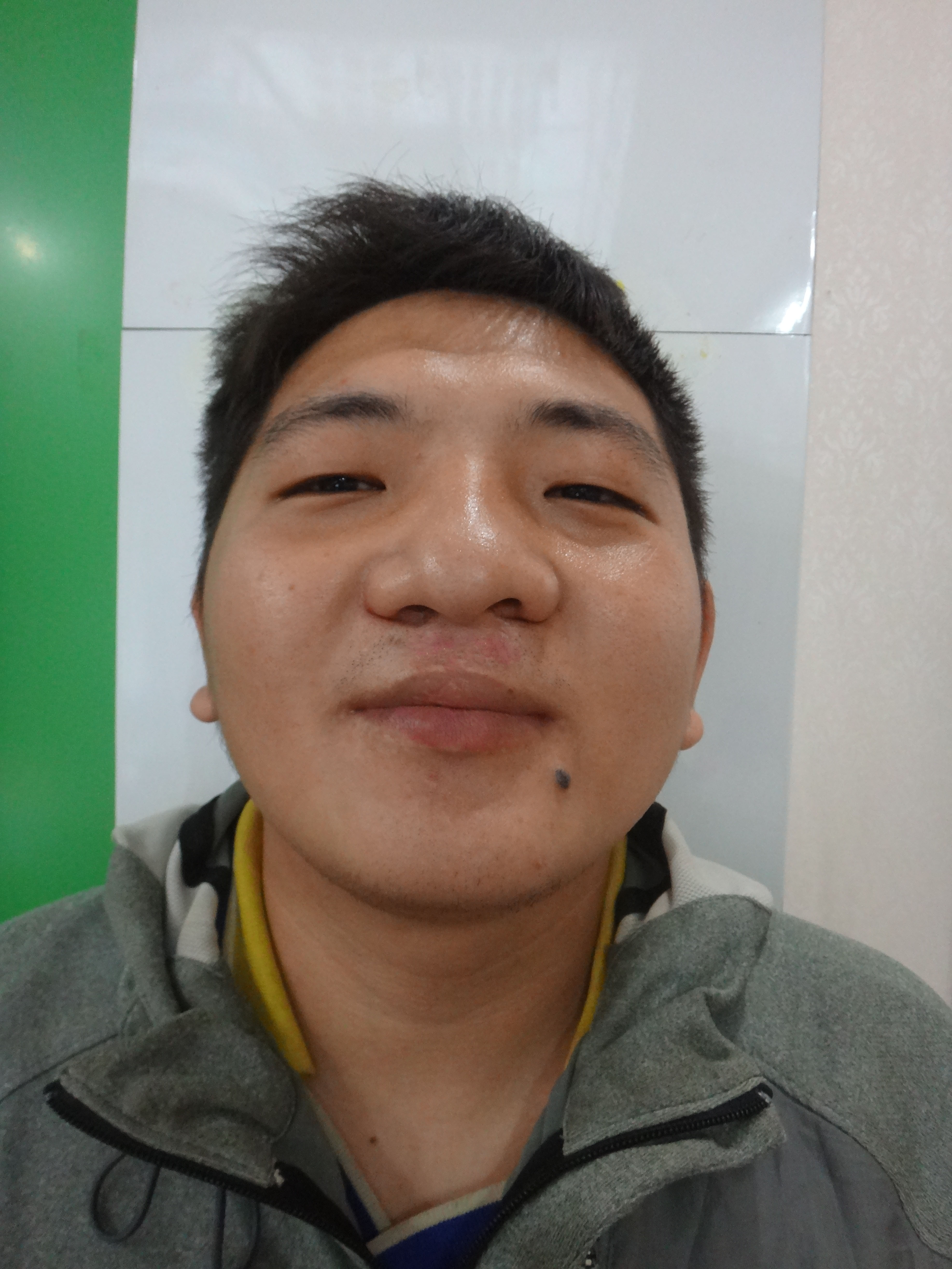 鼻部手术