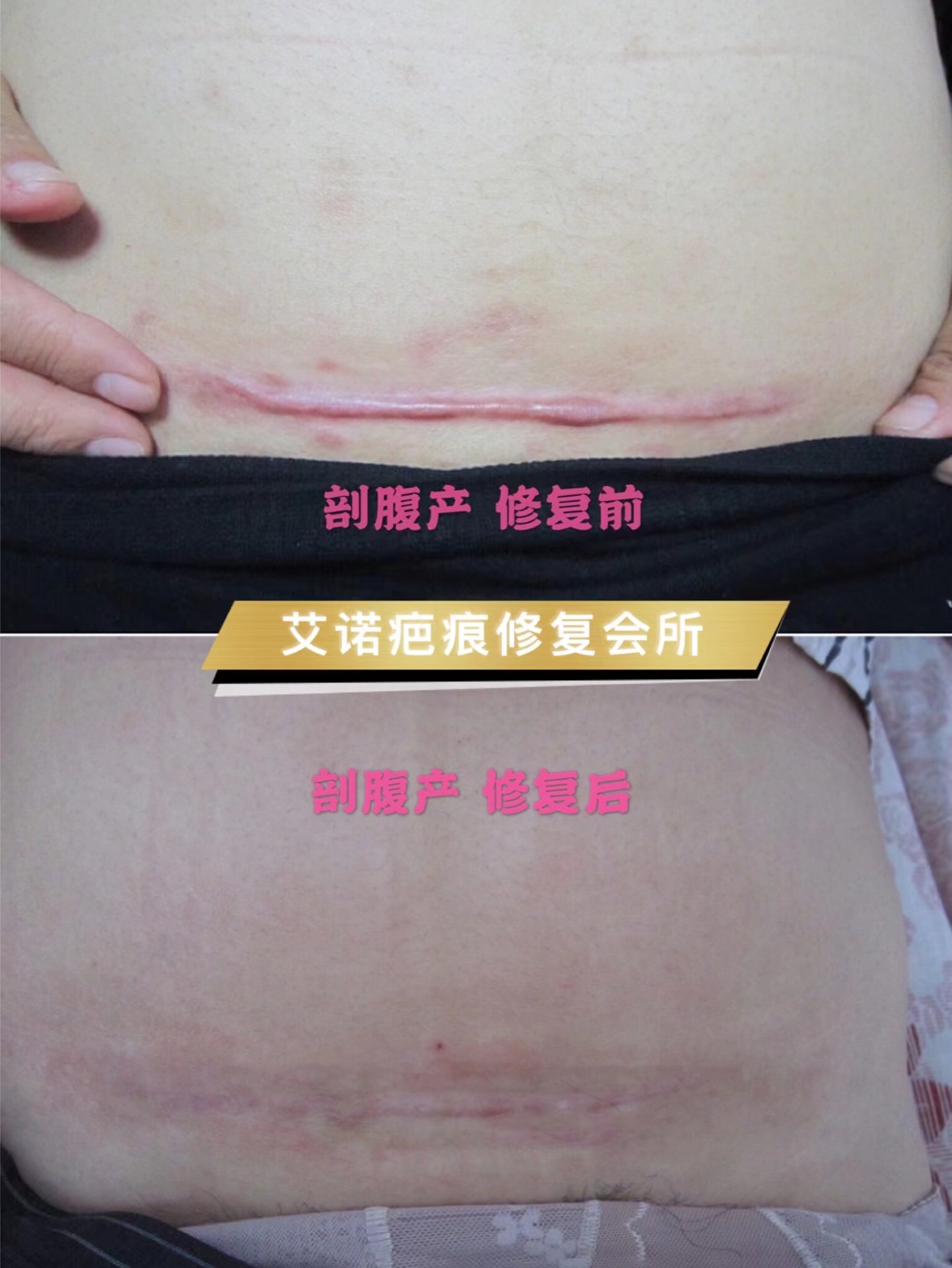 剖腹产术后