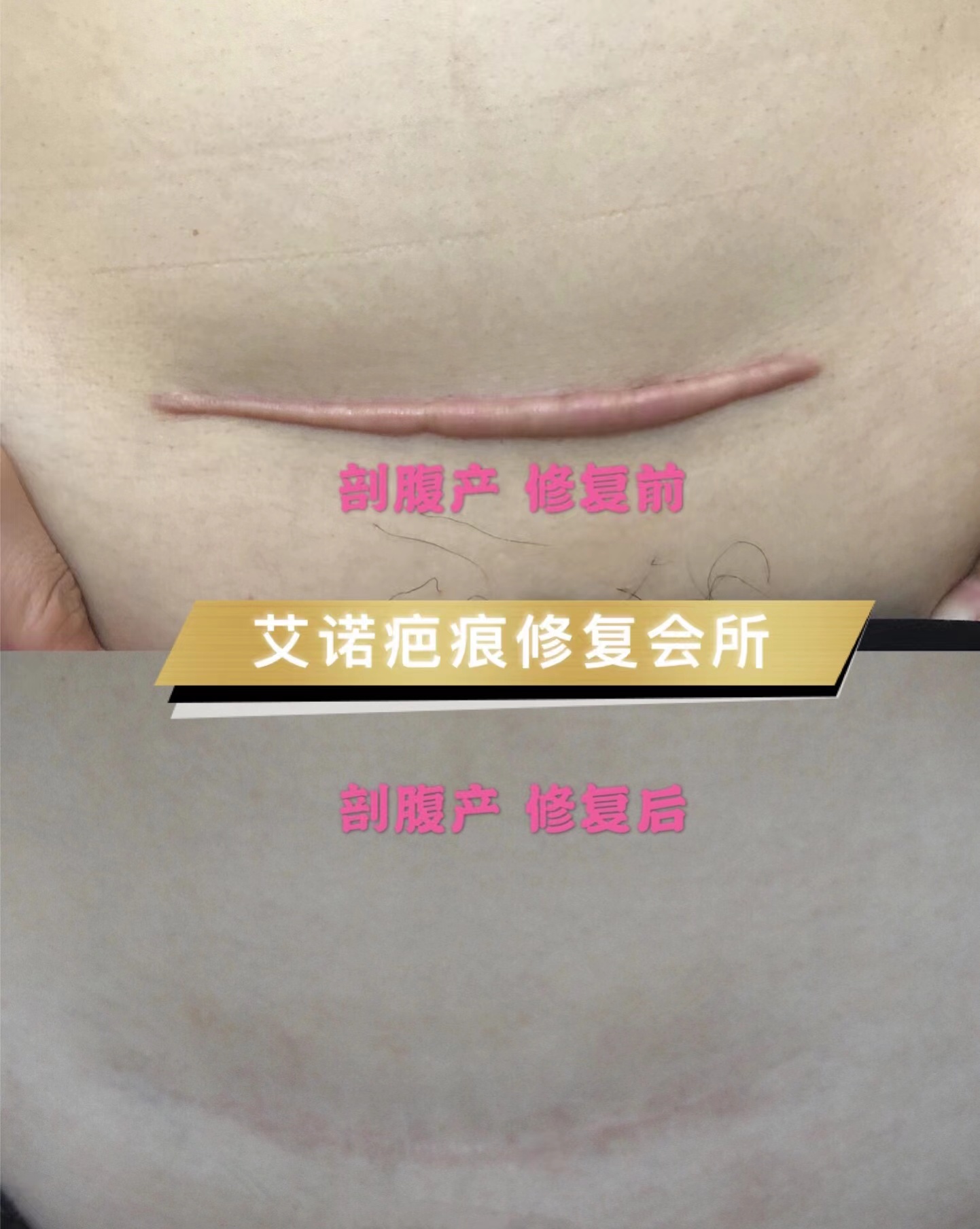 剖腹产术后疤痕