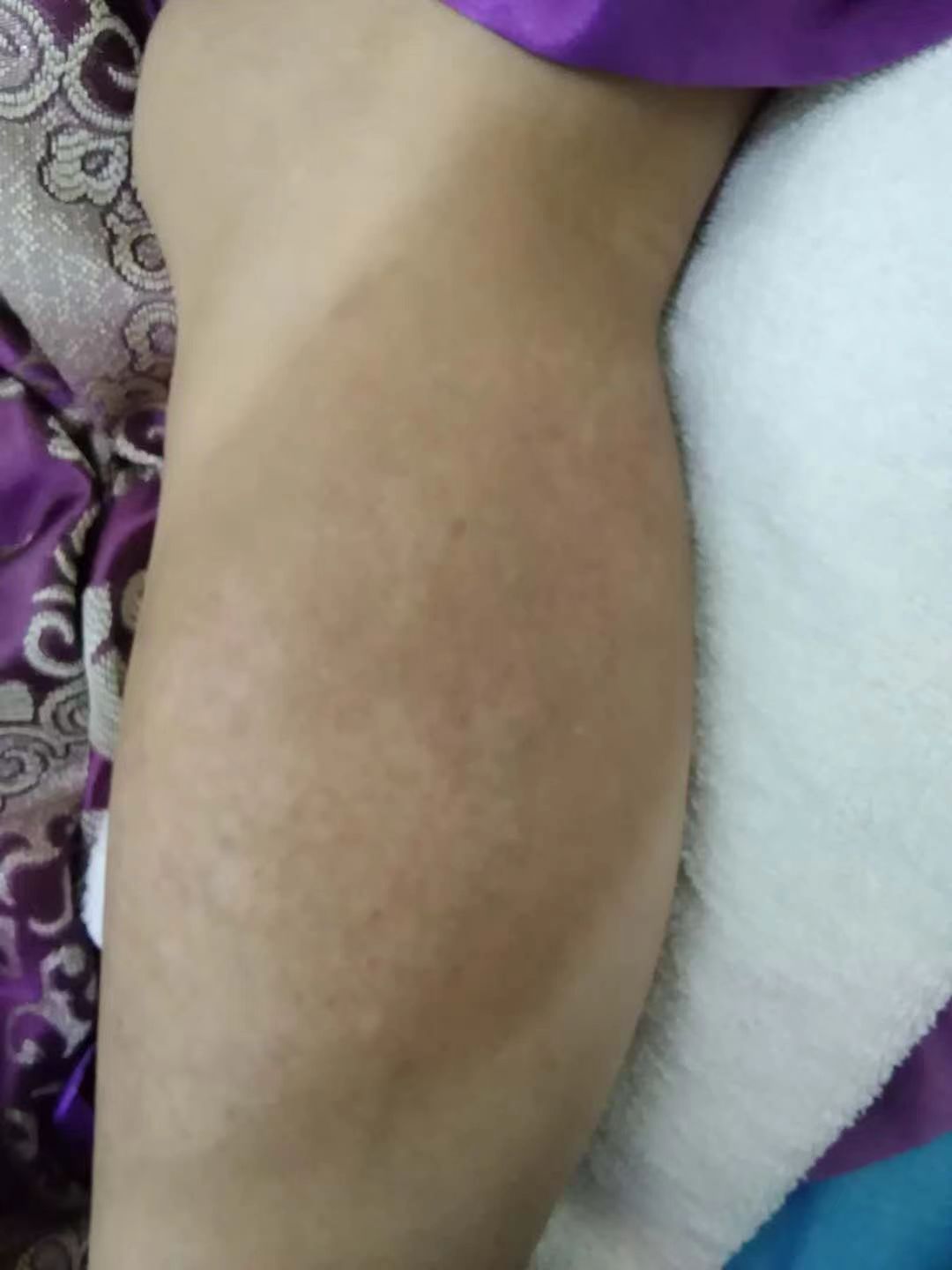 黑色素残留